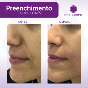 Preenchimento Bigode Chines Fotos  Antes e Depois